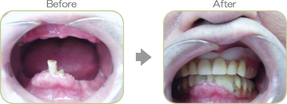 入れ歯の症例１－１