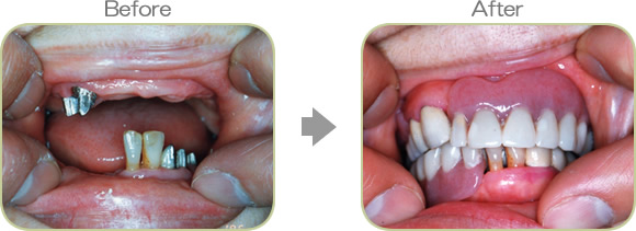入れ歯の代表症例２