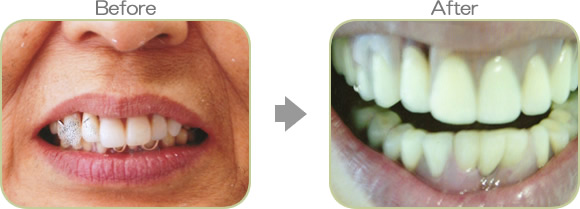 入れ歯の代表症例４
