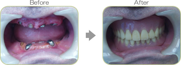 入れ歯の症例７－１